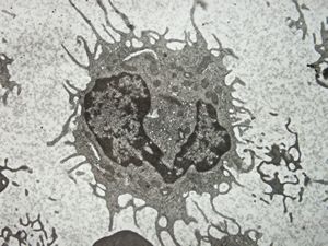 F,59y. | blood - hairy cell leukemia F,59y. | blood - hairy cell leukemia